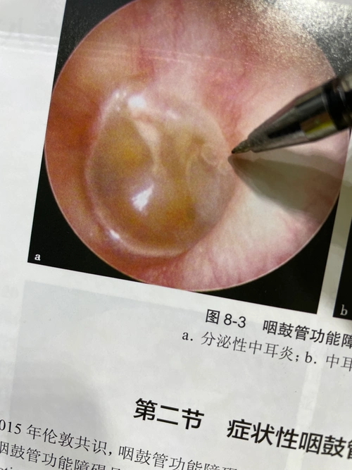来个分泌性中耳炎的病例