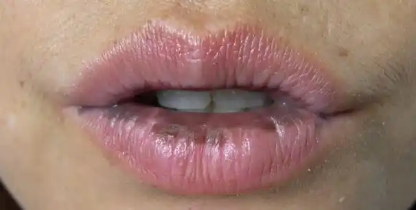 口唇黑斑小心内脏癌(⊙o⊙)