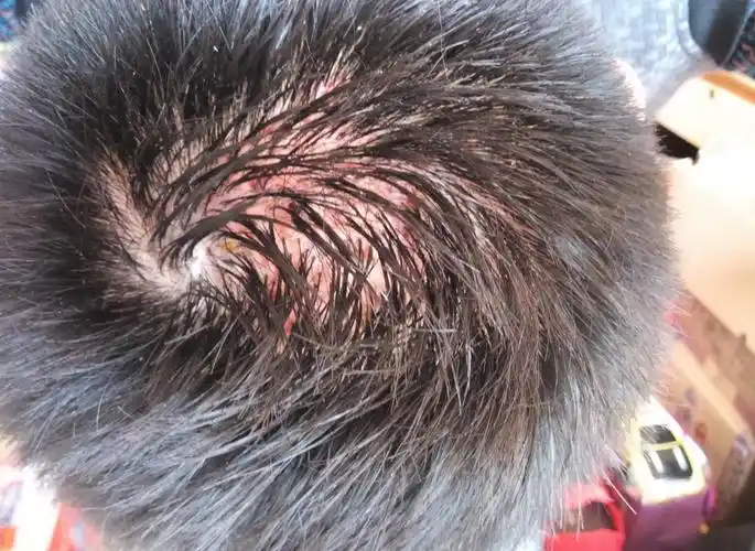 脱发的背后可能是你的毛囊出现了问题