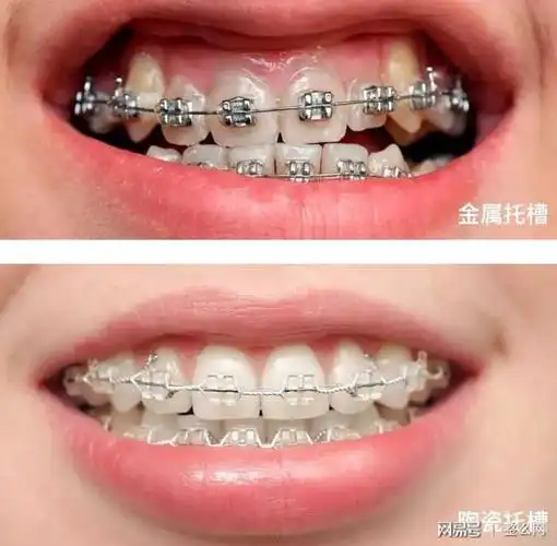 普通牙套与自锁牙套的区别在哪里