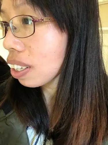 97个人感受:术前因为我嘴巴凸,从小就有一些奇怪的外_圈子-新氧美容