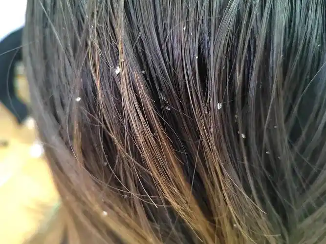 头皮屑很多(有图慎入)