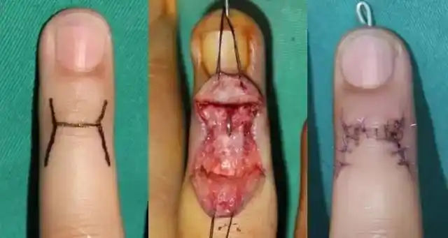 三分钟带你了解手外科常见的疾病锤槌状指