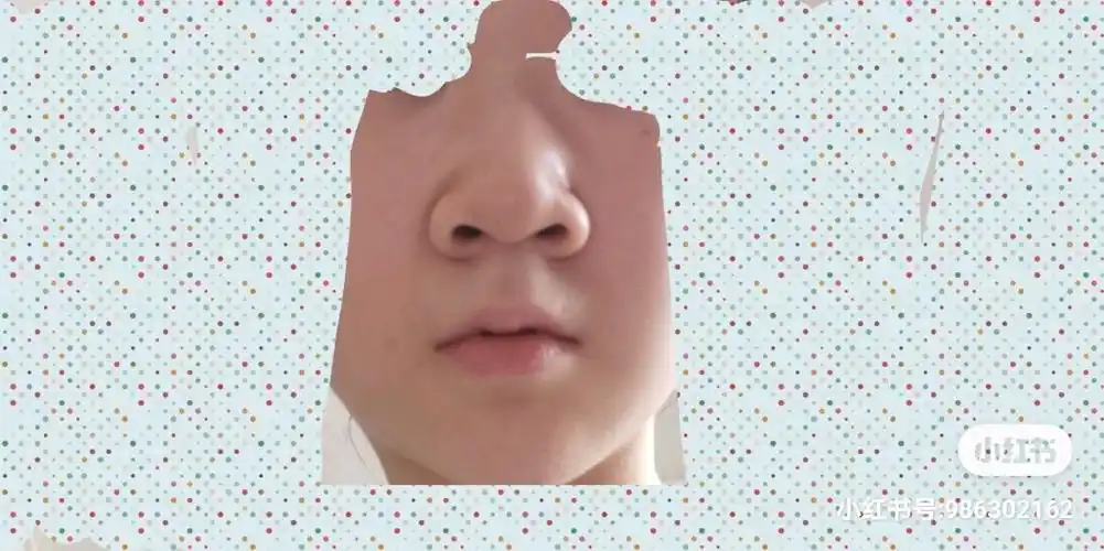 请问我这种鼻子做鼻头鼻翼缩小能改善吗