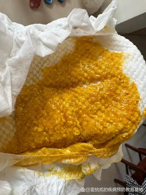 粘液便 宝宝混合喂养,吃奶的时候肚子咕咕响,21天的时候发现粘液便图2