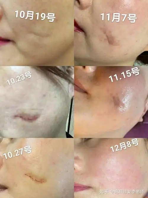 脸上凹陷疤修复50多天终于平了