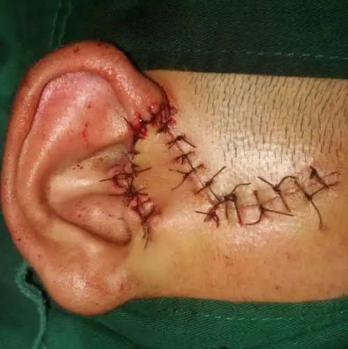 面部菱形皮瓣应用耳前瘘管切除术