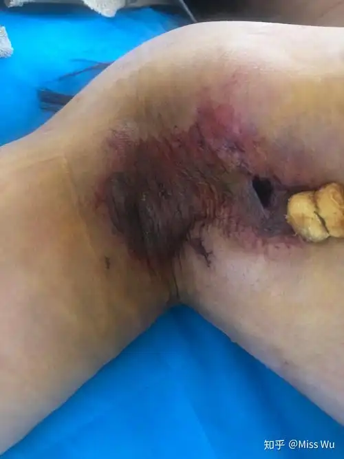 图一是没有做的样子,下面是每天换药时拍的,平时在网上看到的那些太假