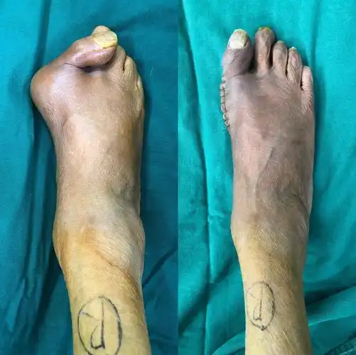 严重拇外翻畸形,做了跖趾关节融合术处理.术前风险感比较大,手术顺利.