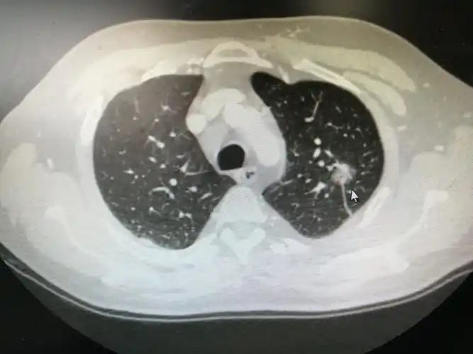 图文教你看懂恶性肺结节的ct表现