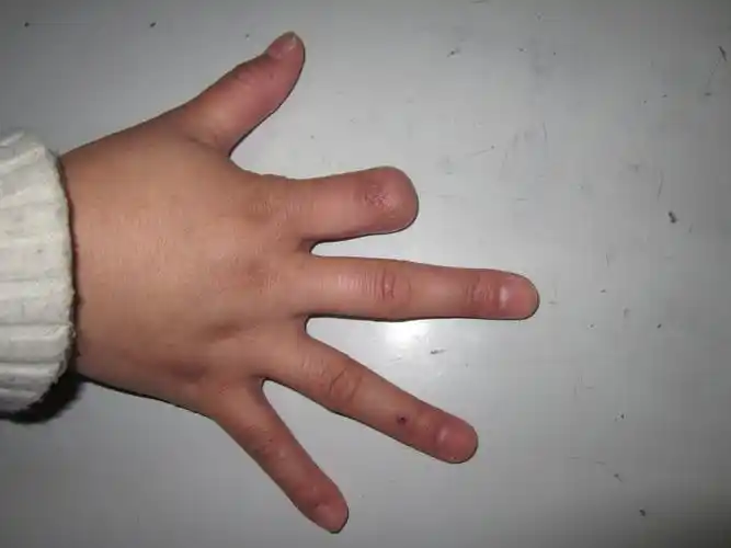 手指缺了怎么办?_断指再植_疾病介绍_治疗介绍 - 好大夫在线