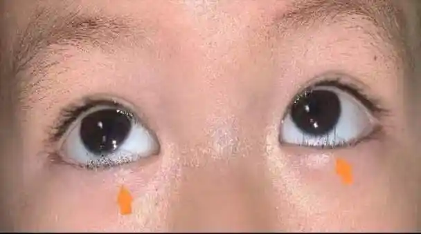 孩子倒睫千万别乱拔!"小毛病"也可引起"大问题"