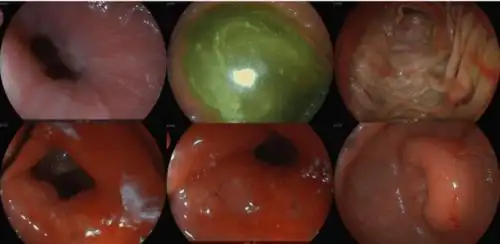 代谢轻微增高,考虑为胃癌残余病灶,请结合胃镜活检结果;中上腹部腹膜