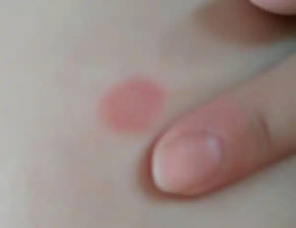 乳房上有红斑几天前有脱皮,现在不痛不痒,胸口其他地方有几个小红疙瘩