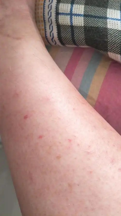 小腿上起的小红点?这是什么病嘛?