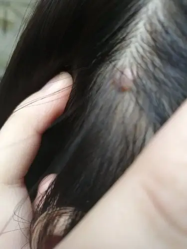 头皮上长了几个硬疙瘩,不疼不痒