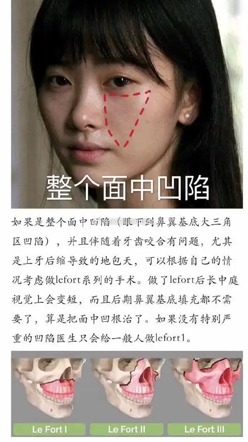 【面中凹陷功课汇总】如果你也有面中凹陷,下眼眶苹果肌三角区发育不