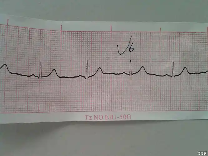 早期复极心电图