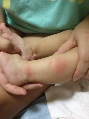 问:宝宝今天右胳膊和左腿起了这样的大红疙瘩,请问是不是蚊子叮咬的