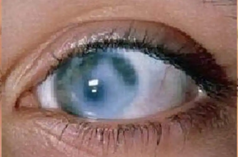 近视不只是看不清还有更大的危害你知道几个