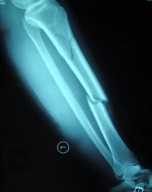 术前左小腿x线如下