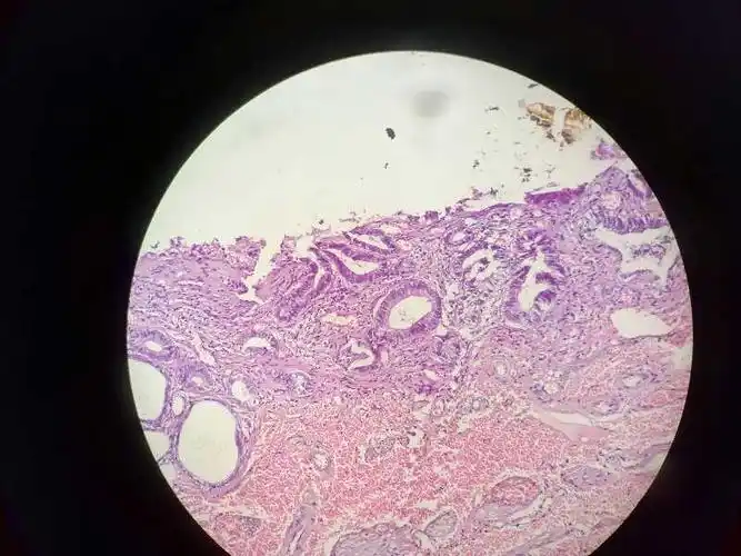 胆囊- 华夏病理网论坛