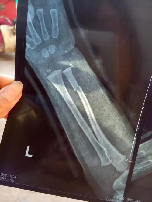 小孩2岁左臂骨折,下面是拍得片,感觉接的有点错位,但医生说没事说长长