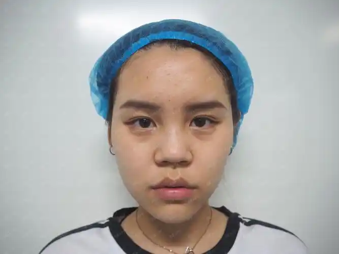 一直不满意自己的塌鼻子,鼻翼还宽,为此我一直很失落_圈子-新氧美容