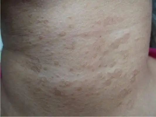 淋病图片_淋病症状表现图片大全_有来医生