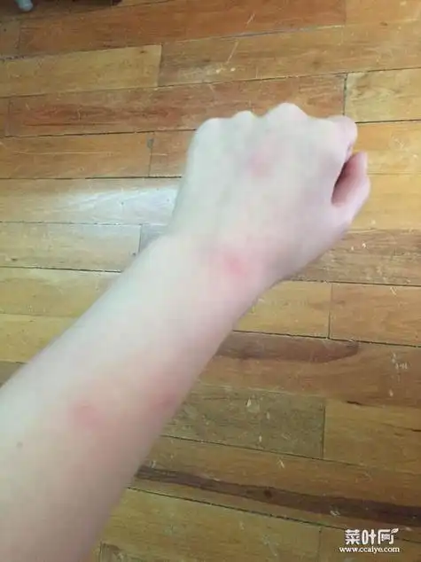 螨虫叮咬后的症状图 长了阴虱虫内裤的图片