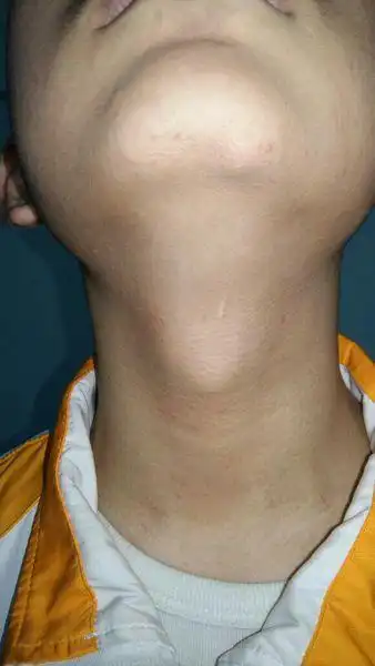 本人男15岁,一年前发现下巴和别人不同,我的中间有