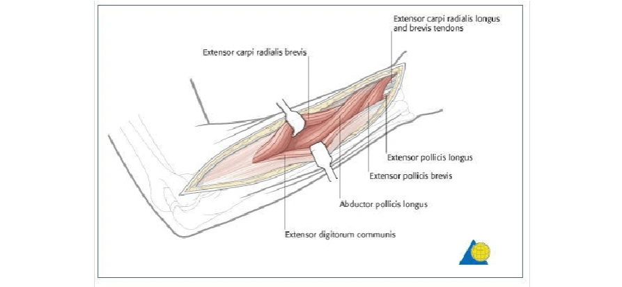 桡骨背外侧手术入路(thompson入路)