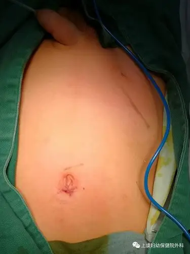 腹腔镜斜疝高位结扎术_疝_疝手术 - 好大夫在线