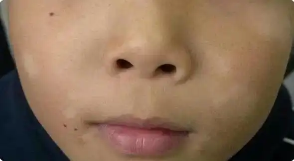 01,孩子脸上长白斑,警惕"蛔虫白斑"
