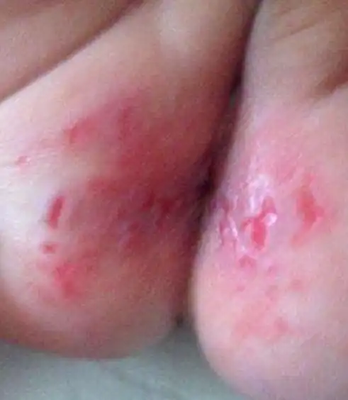 宝宝得了尿布疹需要及时护理,用温水对宝宝患处进行清洗并保持干燥