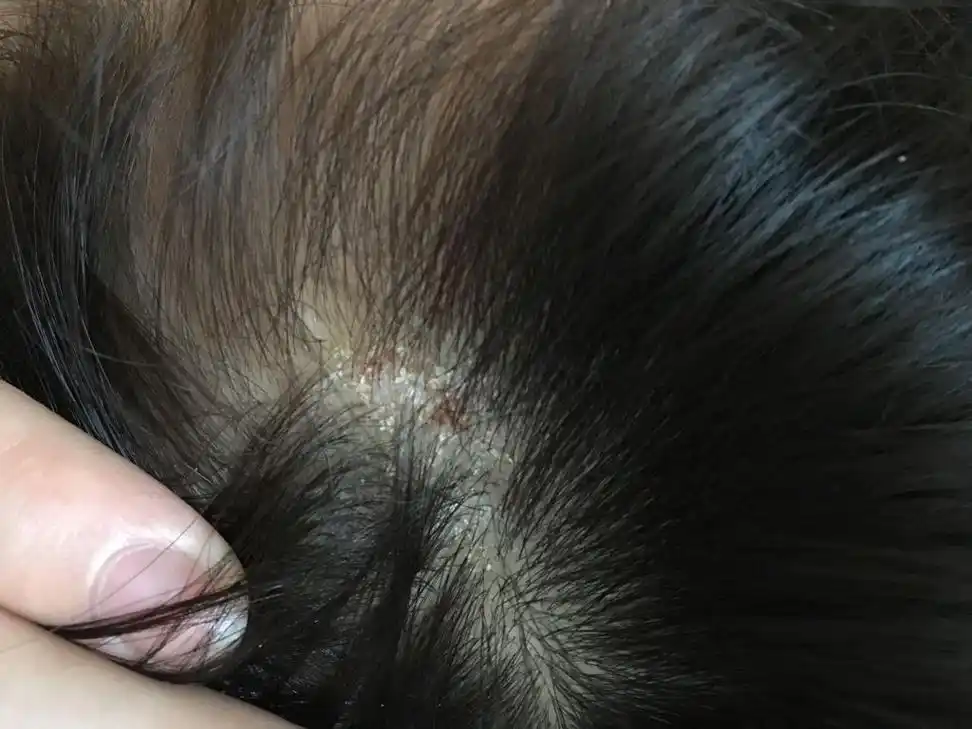 属于真菌感染引起的.