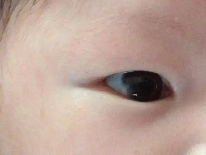 问:宝宝出生后发现右眼球处有一圆形小白膜,虽然不是很大但还是很担心