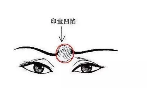 由此可见,印堂凹陷是不好的面相特征,若女子印堂塌陷,更是不利运势.