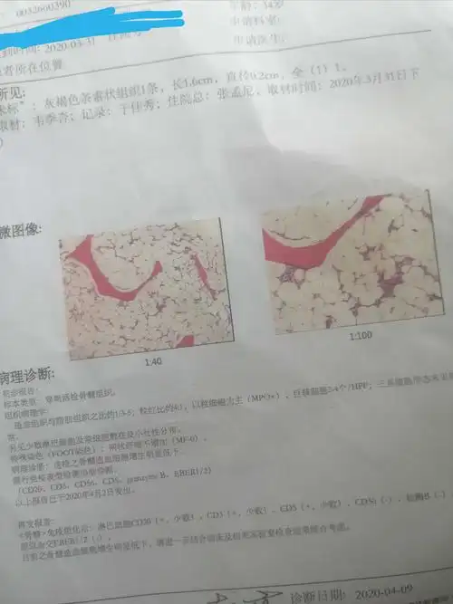 看看我的骨髓免疫组化