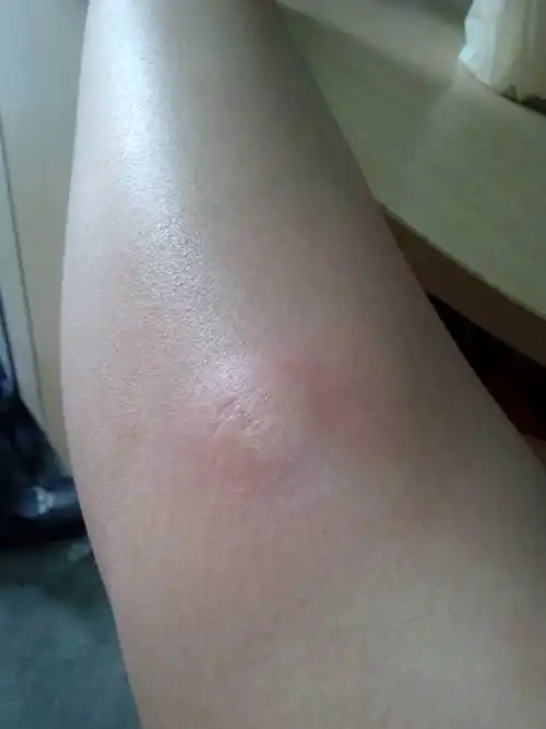 昨天被虫子还是蚊子咬起的包现在好几个.很大很肿.不知道怎么办.