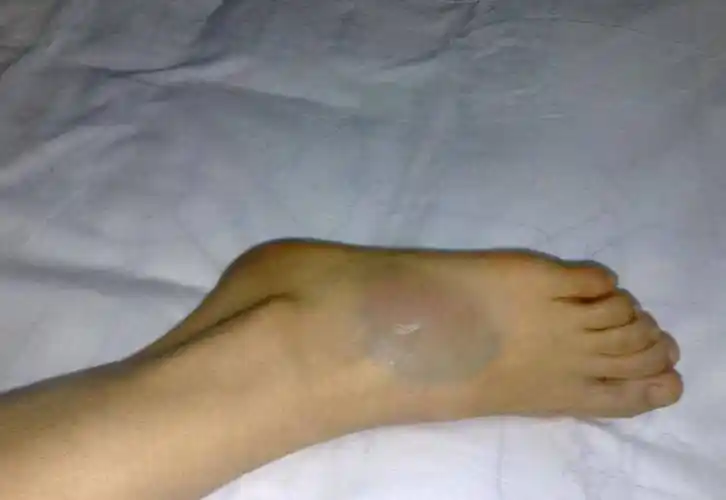 崴脚别忽视,当心发展成习惯性踝关节扭伤!_运动_时候_脚踝