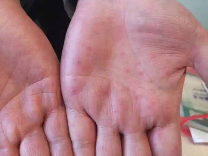 手足口病or多形红斑