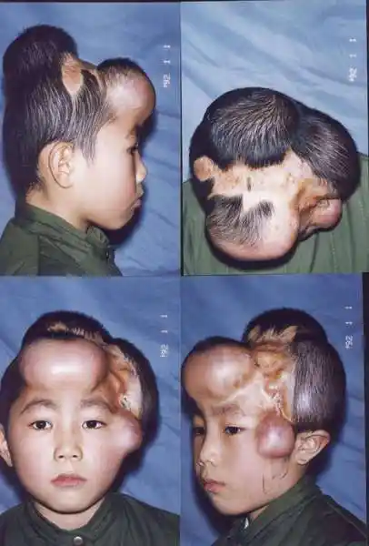 头皮及面部瘢痕的扩张器治疗