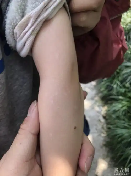 小孩手臂有白色斑点去哪里看