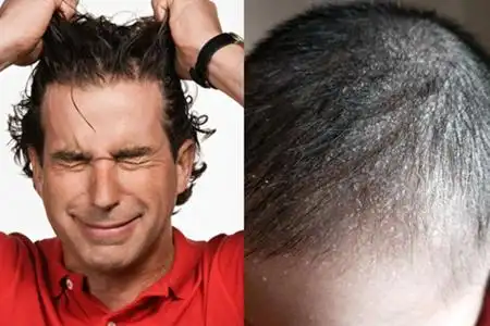 头皮干燥头屑多很痒怎么治 记住这几招就好