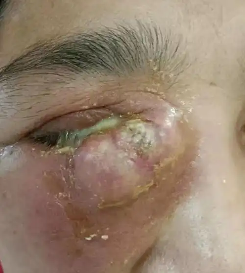 50岁阿姨眼睛肿成"馒头",急性泪囊炎原来这么可怕?