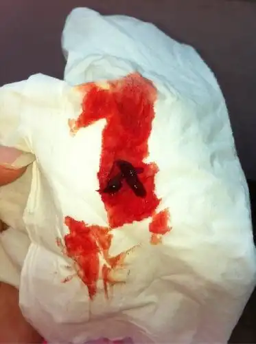 便秘,刚大便后擦的肛门有血,还有血丝,是