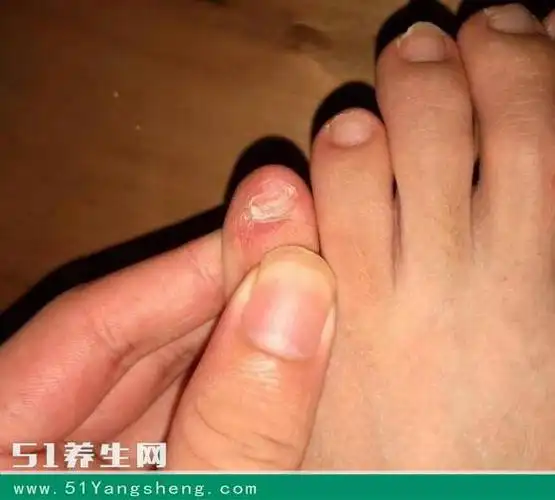 小脚趾甲是分成两瓣?你知道怎么回事吗?