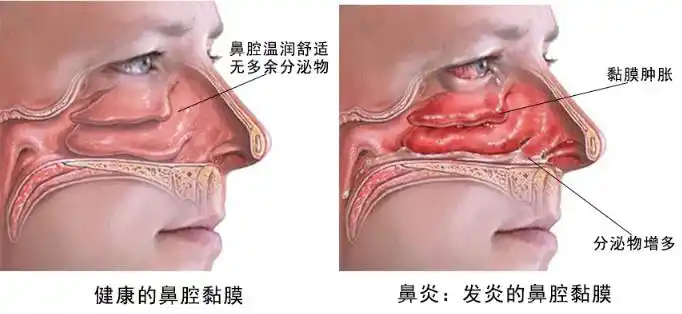 鼻炎的症状有哪些?怎么治效果最好?