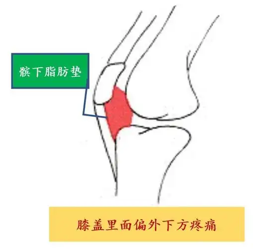 髌下脂肪垫炎——临床常见的膝关节前外侧疼痛原因之一_关节痛_关节痛